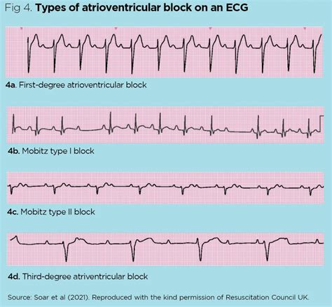 abnormal ekg readings